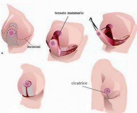 MASTOPLASTICA RIDUTTIVA - Dott. Massimiliano Tripoli