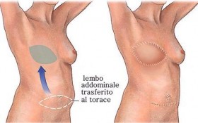 RICOSTRUZIONE MAMMARIA - Dott. Massimiliano Tripoli