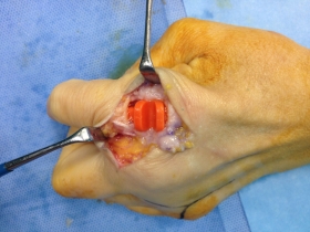 Artroplastica digitale con protesi in silicone - Dott. Massimiliano Tripoli